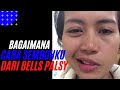 sembuh dari bells palsy