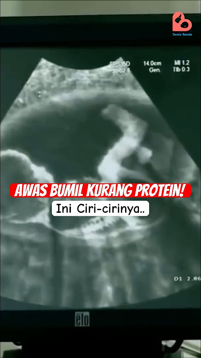 Awas Bumil Kurang Protein saat Hamil #kehamilan