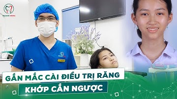 Gắn Mắc Cài Điều Răng Khớp Cắn Ngược Khấp Khểnh Lệch Lạc Cho Bạn Khách Hàng.