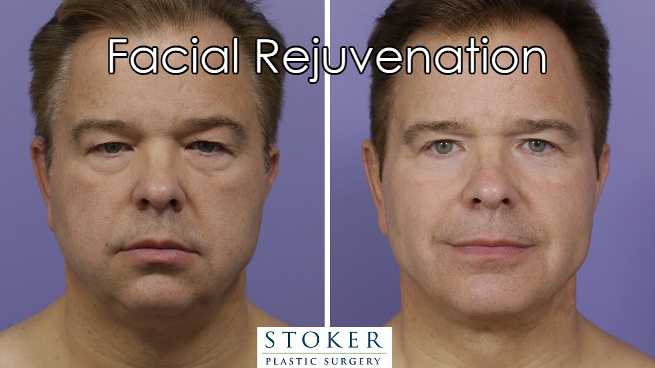 Male Facial Plastic Surgery Los Angeles Dr. Stoker Reviews His