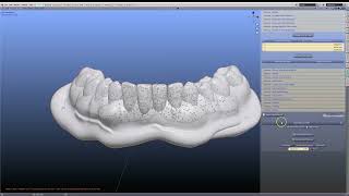 🔥 Relining a denture — the smart way