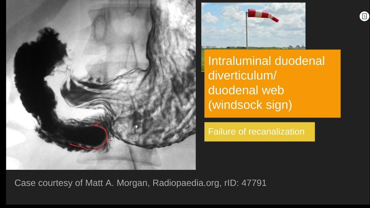 Intraluminal duodenal diverticulum/duodenal web (windsock sign) 