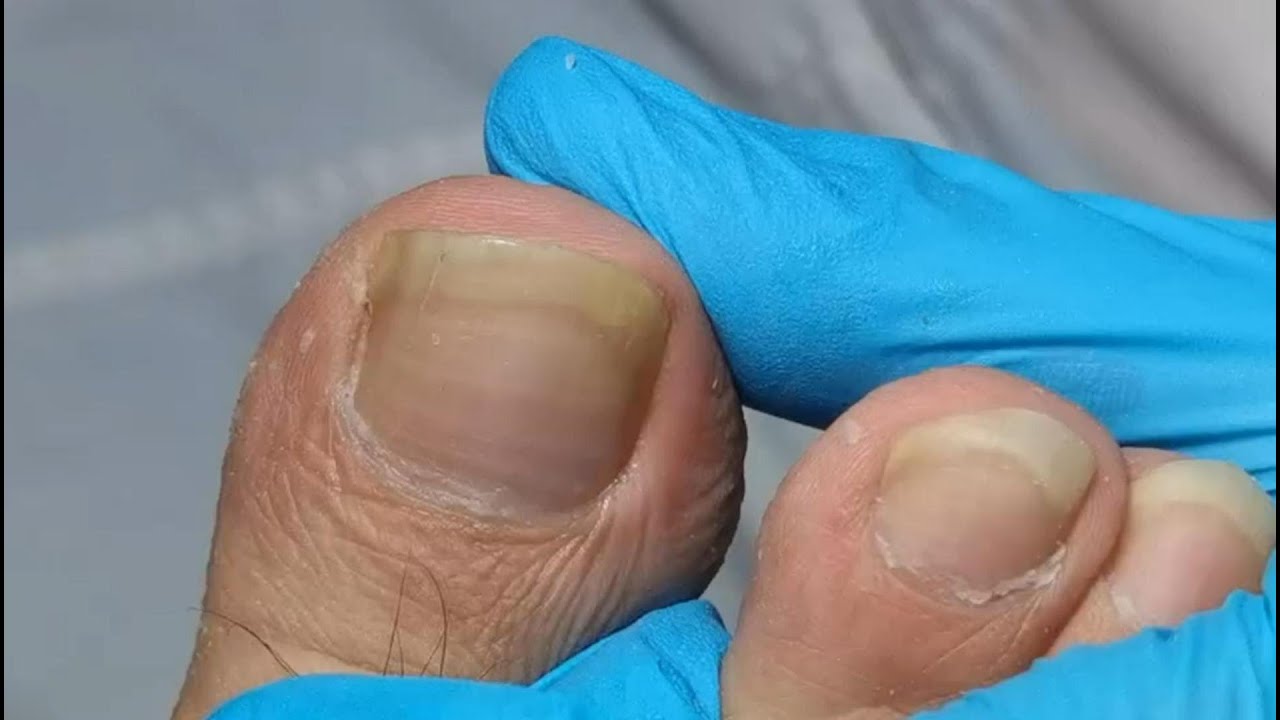 Hoof trim! Let me cut the nails one by one. Fungus nails treatment