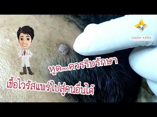 รักษาหูด EP.2 /หูด...ควรรักษาเพราะเป็นเชื้อไวรัสที่แพร่ไปสู่คนอื่นได้ @หมอปุ๊ Neramit Clinic