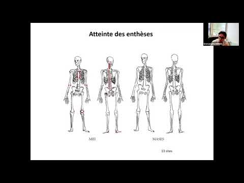 Vidéo: 3 façons d'atténuer la raideur matinale de l'arthrite psoriasique