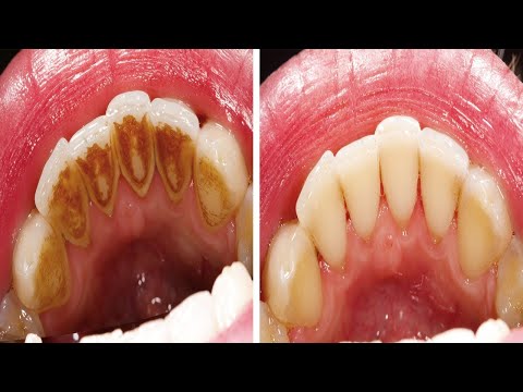 Video: Müssen Zahnärzte lange Ärmel tragen?