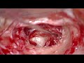 Left Mastoidectomy with Ossiculoplasty using Autologous Incus and Cartilage by Dr.Meenesh Juvekar