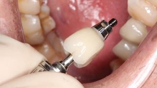 Full Contour Zirconia Implant Crown Insert(1500000 views on the channel https://youtu.be/dAzTx8yteAs - expert tip! Dr. Scott MacLean inserts a FCZ crown on a 5.5 mm wide platform NobelActive implant ..., 2015-05-27T00:48:02.000Z)