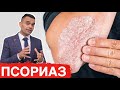 2 Лучших Средства Для Лечения Псориаза - Лечение Псориаза | Доктор Вивек Джоши