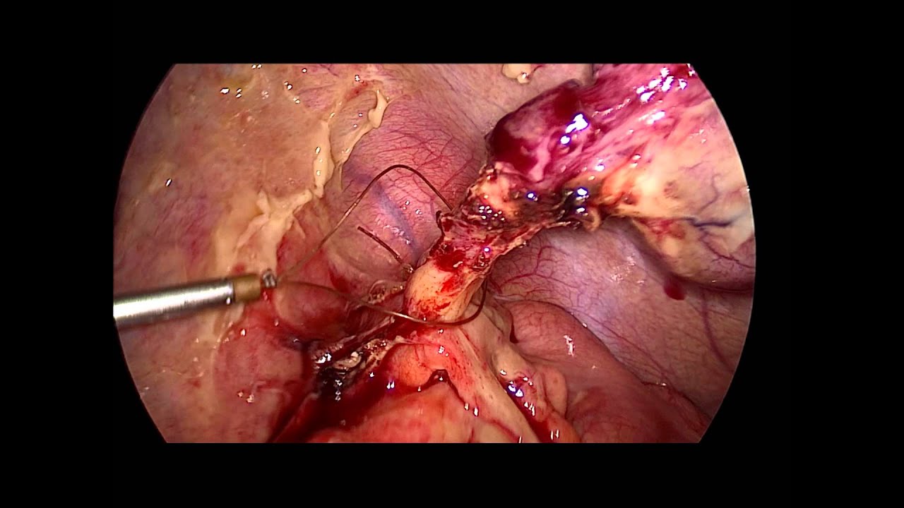Perforated Appendicitis Laparoscopic Appendectomy Youtube