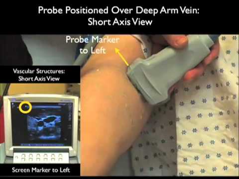 Peripheral Venous Access Under Ultrasound Guidance - Part 1 - SonoSite, Inc. - YouTube