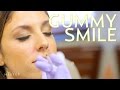 Fix a Gummy Smile with Botox + Giveaway Winner! | The SASS with Susan and Sharzad