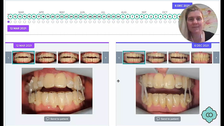 Fixing An OPEN BITE With Clear Aligners | Orthodontist in Houston, TX