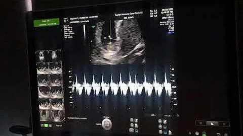 Hearing the heart beat for the first time  #firstt...