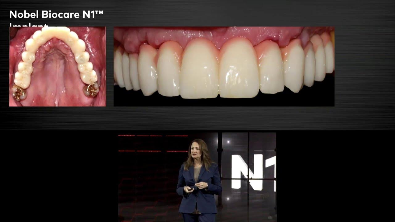 Clinical experience developing the Nobel Biocare N1™ concept YouTube