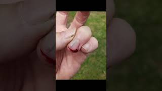 Emergency First Aid :  Removing a splinter from under a fingernail.