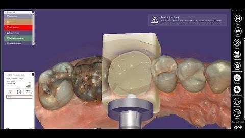 CS 3600 Scan - exocad Design - CS 3100 Mill