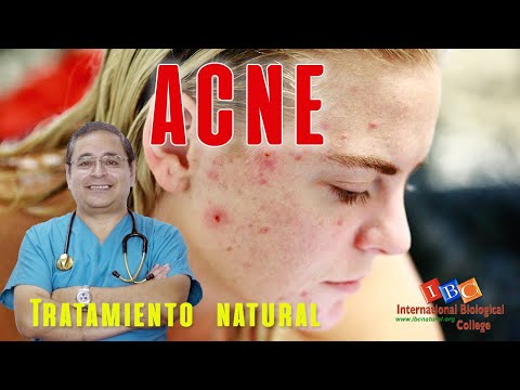 Vídeo: Opciones De Tratamiento Del Acné Nodular Y Remedios Caseros