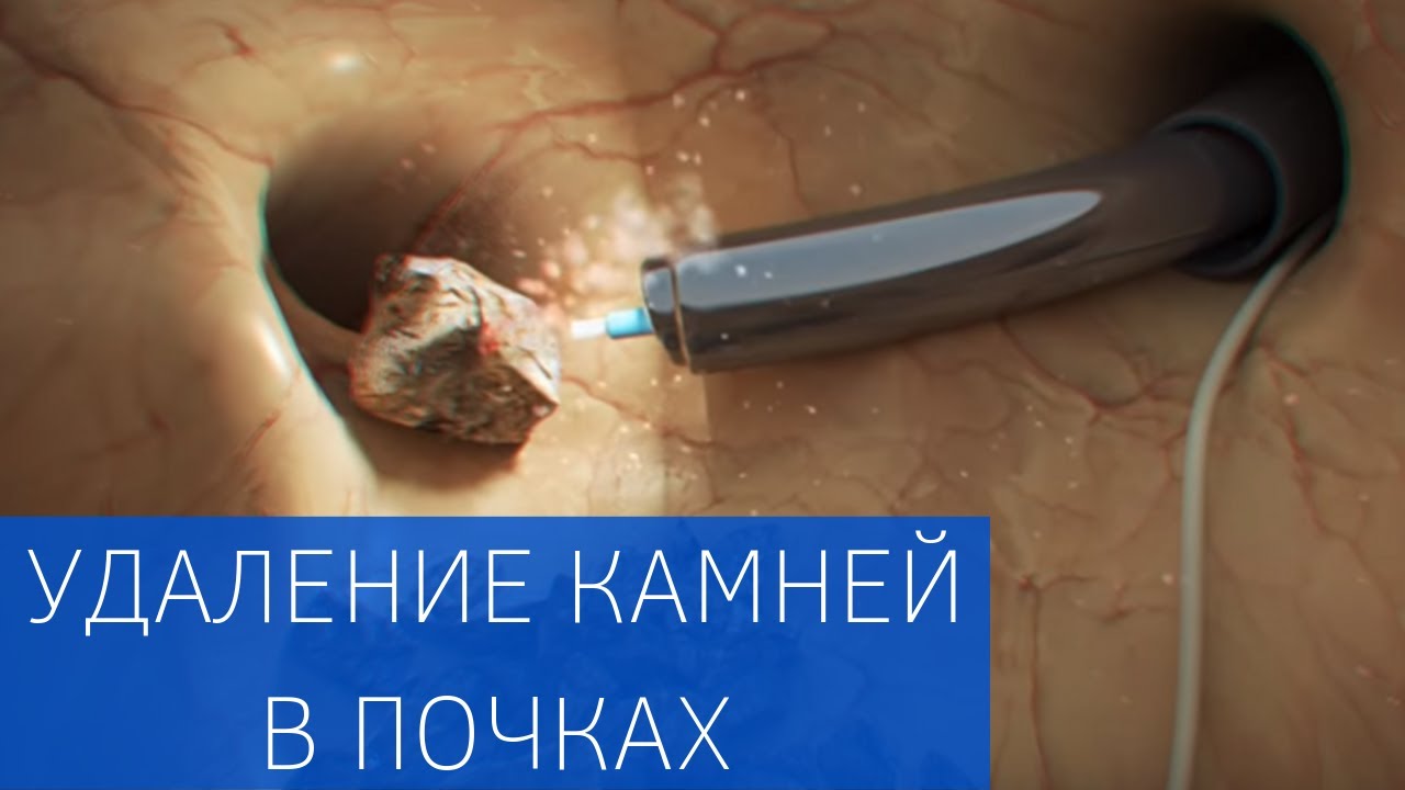 уратный камень в почке