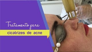 Laser tratamento penang a para acne