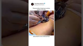“This procedure helps burn victims grow new skin 😳”#SkinGrafting #Surgery #MedicalScience #Surgery