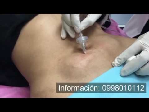 Como funciona la carboxiterapia para adelgazar Como funciona la carboxiterapia para adelgazar