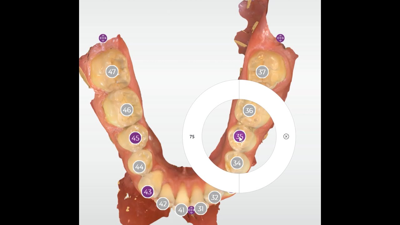 Primary tooth number in CEREC Ortho 2.0.2