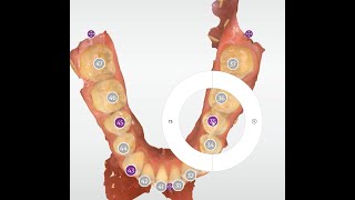 Primary tooth number in CEREC Ortho 2.0.2