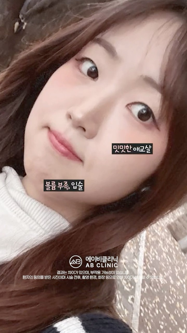 애교필러, 입술필러 직후 효과