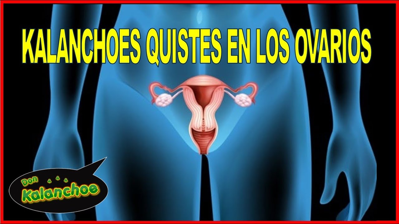 Quistes En Los Ovarios Tratamientos Con Kalanchoe Youtube