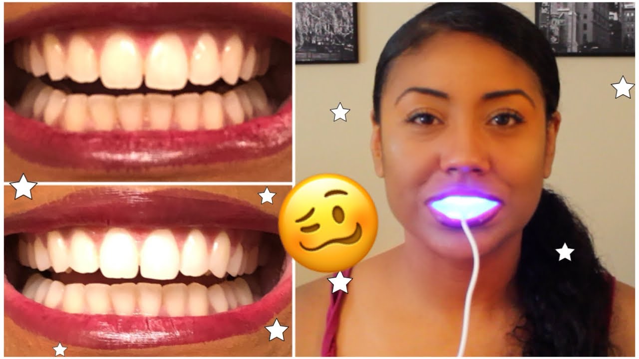 Makkelijker maken account omhelzing I Tried Smile Direct Teeth Whiten and THIS is What Happened 🥴 (thorough  review w/ pics) - YouTube