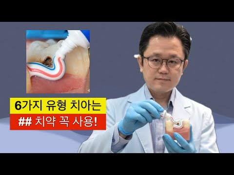 How to choose a toothpaste that prevents cavities?