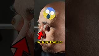 He Can POP His Eyeballs Out 19mm?! (You Won't Believe This!)