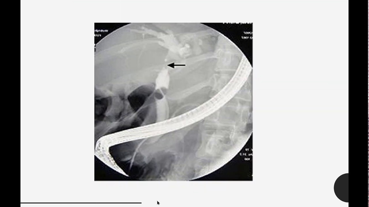 Liver 2:Liver Abscess and Cysts (Surgery)