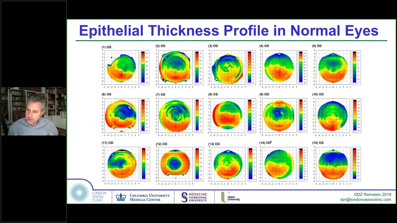 Laser Eye Surgery Wavefront Guided, Wavefront Optimised, SMILE vs LASIK vs TransPRK vs ICL