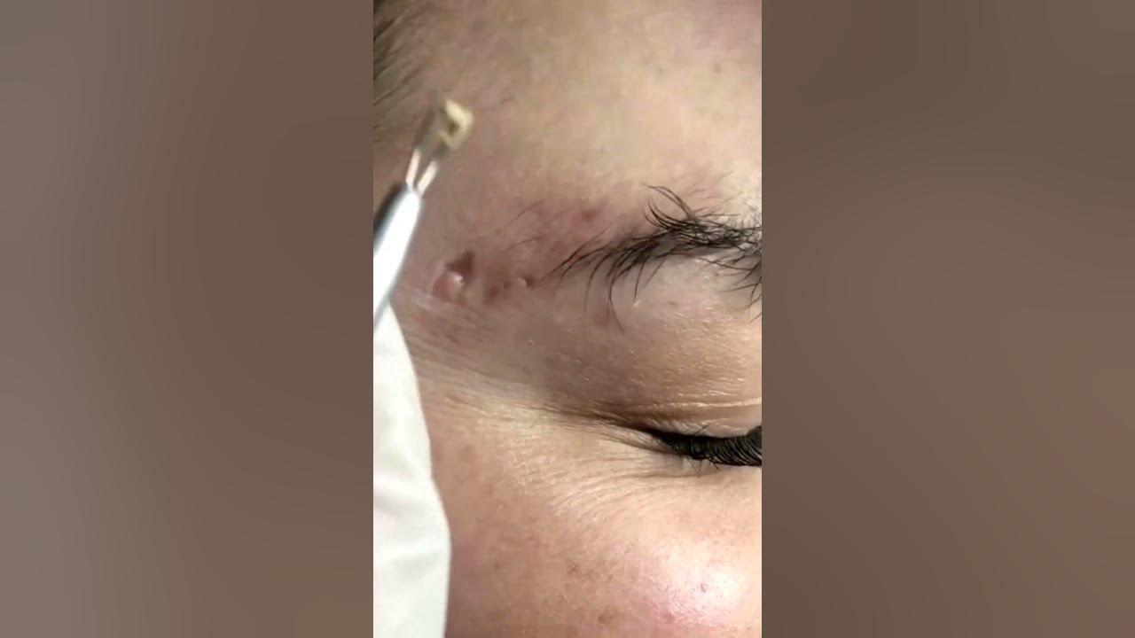Huge blackheads extraction Pimple popper blackhead on face YouTube