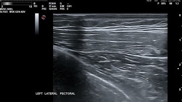 Diagnostic Nerve block to the lateral pectoral nerve