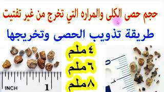 كيفية علاج حصوات الكلى والحالب حسب حجمها يوتيوب