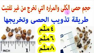 كيفية علاج حصى الكلى والحالب حسب الحجم