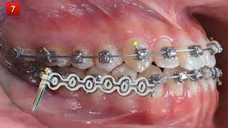 Nonsurgical correction of a Class III malocclusion with miniscrews｜【Chris Chang Ortho】CC565