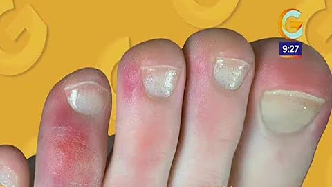 ¿Qué es el síndrome del dedo morado?