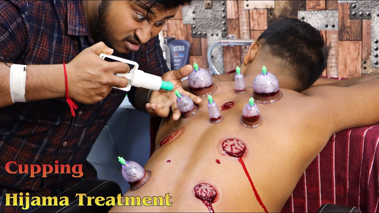 Cupping  Hijama Treatment for Better Blood Circulation  Step By Step Process Relaxing ASMR