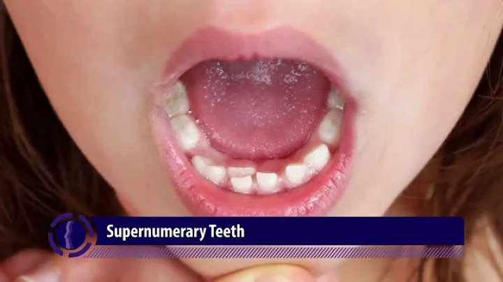 Supernumerary Teeth | Abnormalities in Tooth Quantity- 1 - DayDayNews