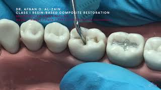 Class I composite restoration (2) – Slanting/oblique incremental technique (#36)  Arabic عربي