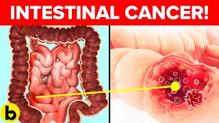 8 Signs Of Intestinal Cancer That You Should Be Aware Of