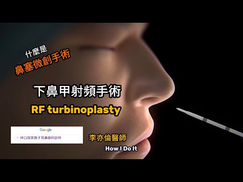 鼻塞微創手術 下鼻甲射頻手術 短影音版