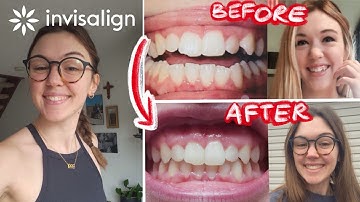 MY 10 MONTH INVISALIGN JOURNEY || smile transformation