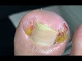 Nail almost go through the toe(bad case)