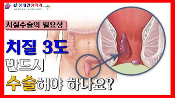 치질 3도 반드시 수술해야 하나요?