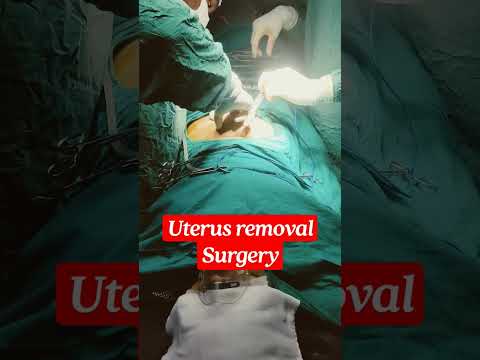 Video: Er hysterektomi en større operation?